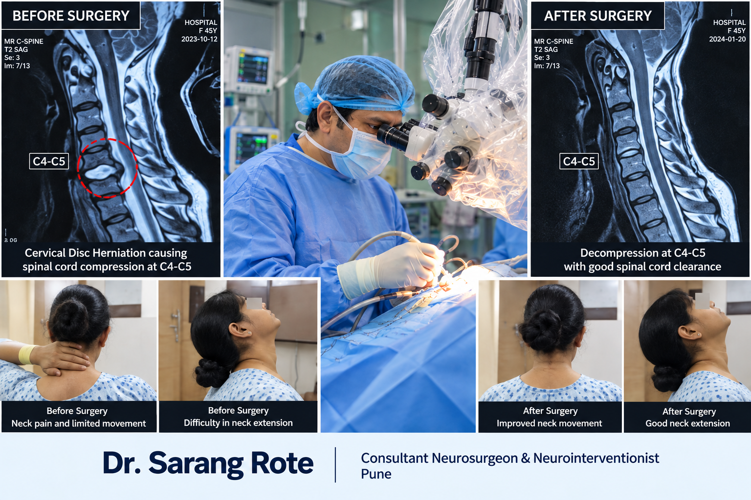 Spine Surgery by Neurosurgeon in Pune